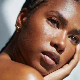Tratamento de melasma em pele negra: MelasylTM reduz manchas sem alterar o tom natural da pele